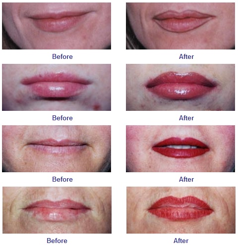 before and after lips